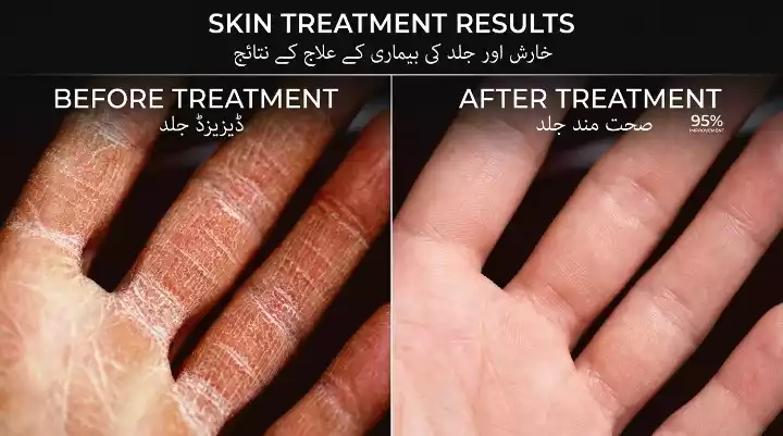 Skin disease treatment results with homeopathy in Pakistan