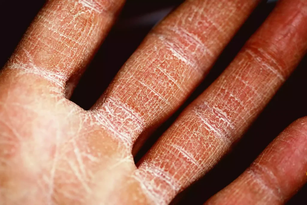 Homeopathic treatment for eczema skin disease in Pakistan